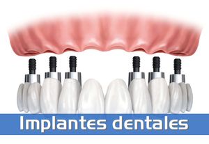 Clínica Dental Centro de Implantología Inocencio Paz Sánchez implantes dentales