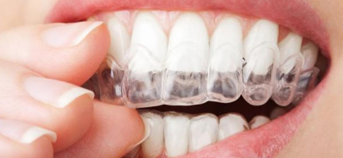 Clínica Dental Centro de Implantología Inocencio Paz Sánchez dientes con trabajo de ortodoncia